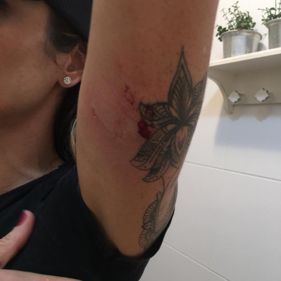 A empresária Lorena Ferreira Santos teve o braço mordido por um poodle ao tentar apartar o ataque ao cão de que é dona